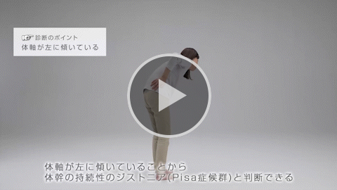 ジストニア3