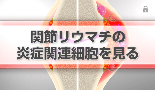 関節リウマチの炎症関連細胞を見る